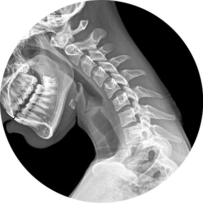 Рентген снимки остеохондроза | Второе мнение